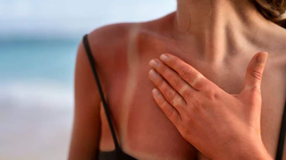 How to get rid of sunburn?  Experts shared tips