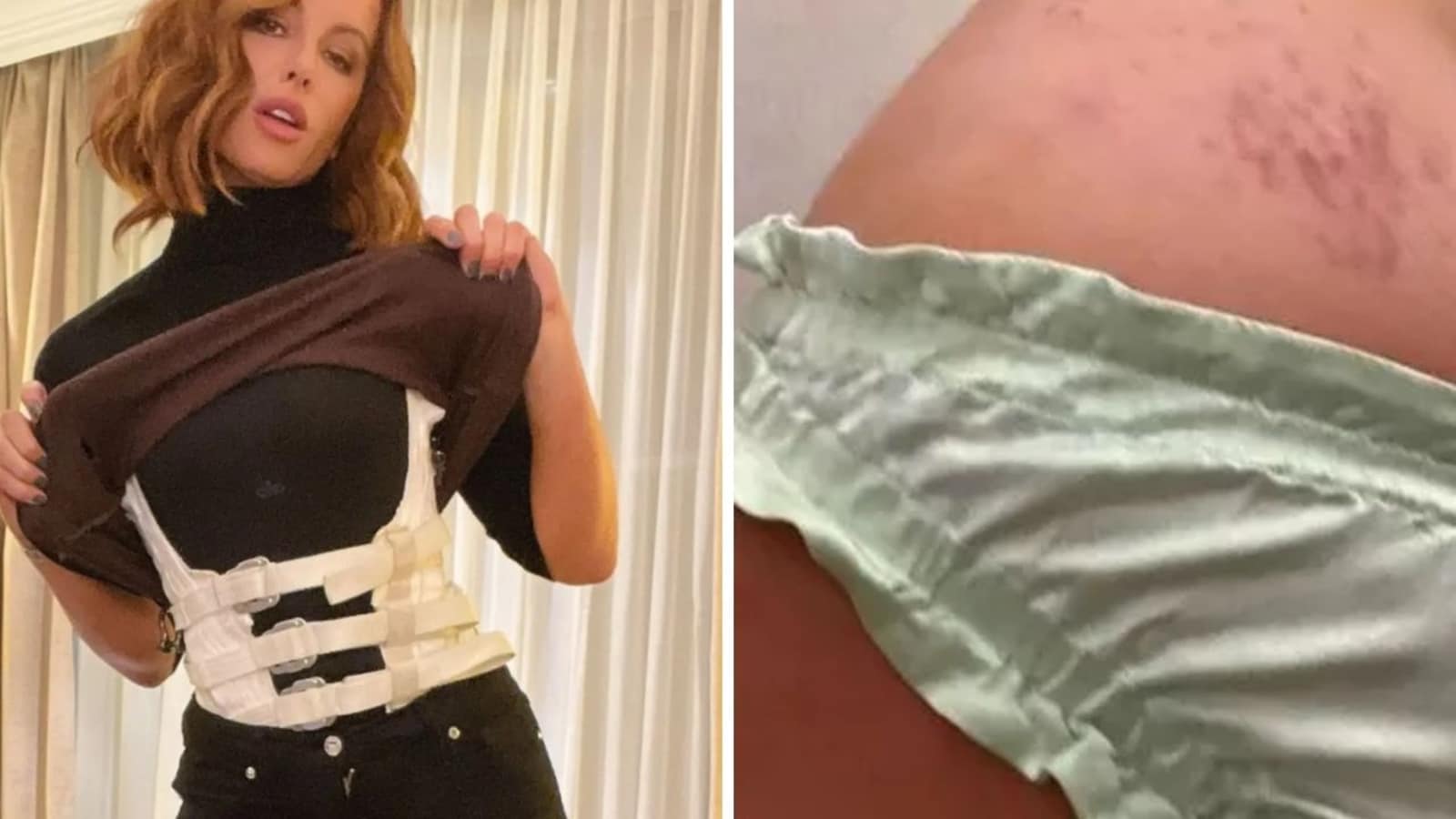 Kate Beckinsale posts disturbing photos of bruises and injuries: What happened to her?