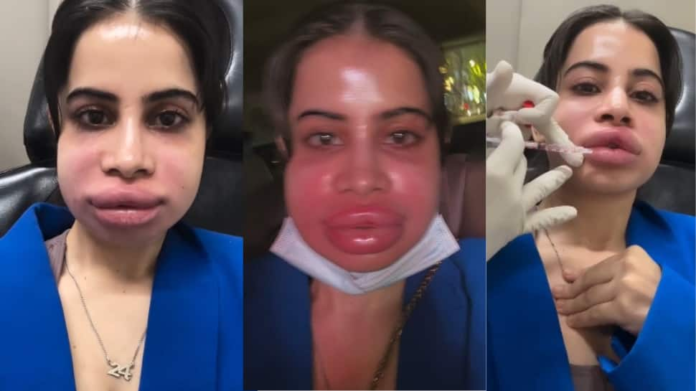 Viral video: Uorfi Javed The lip -filler removed after 9 years, the shocking reason tells - clock

